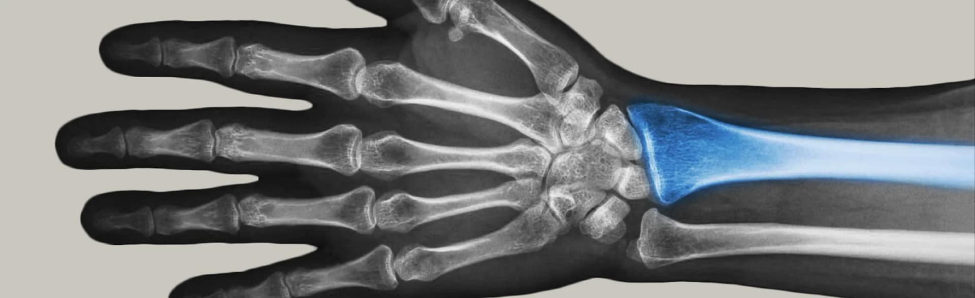 Distal Radius Fracture Illustration of a Distal Radius Fracture