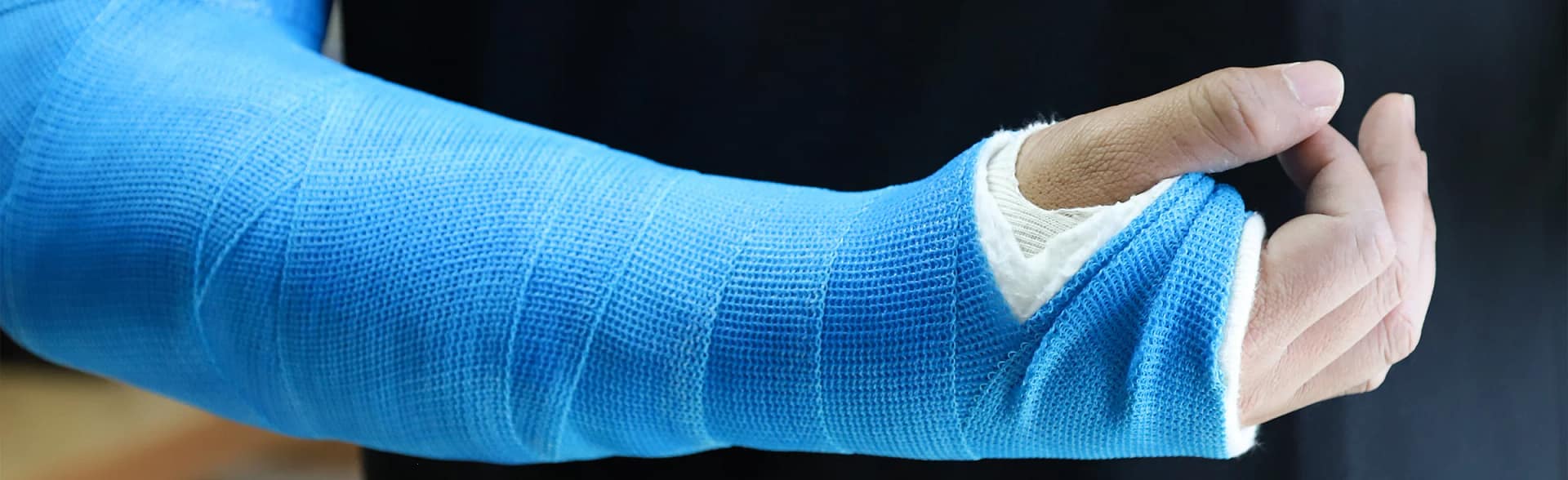 Forearm Fractures Forearm fracture in a cast